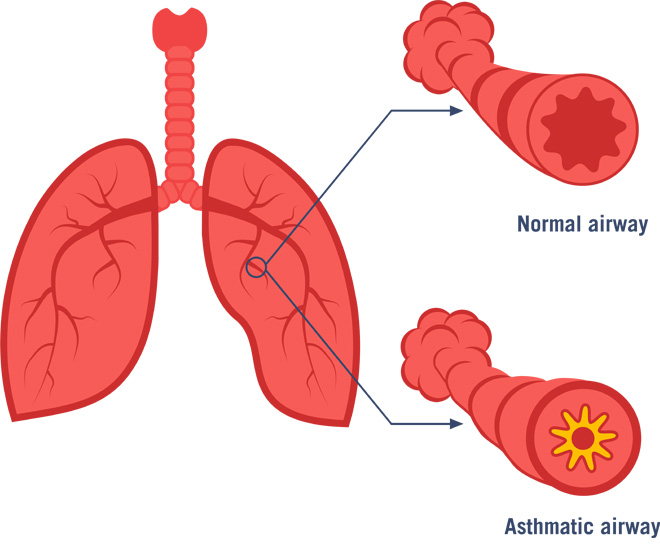 Asthma